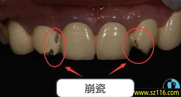 烤瓷牙崩瓷粘补图片 烤瓷牙裂了能粘回去吗