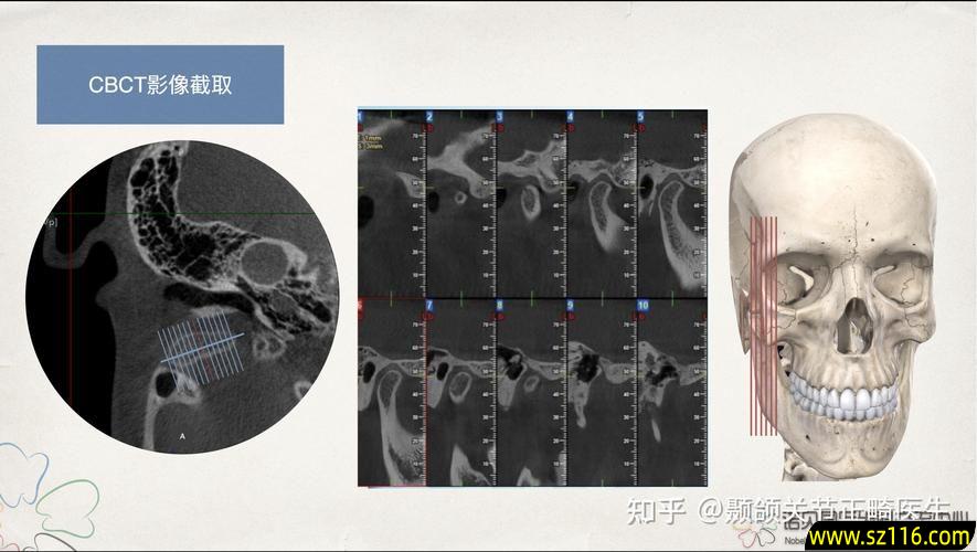 颞颌关节磁共振烤瓷牙(烤瓷牙影响做核磁共振吗)