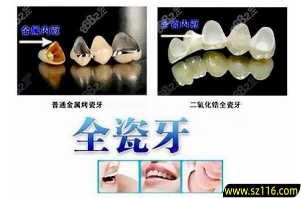 钛金烤瓷牙的价格陕西？镍铬合金烤瓷牙费用是多少