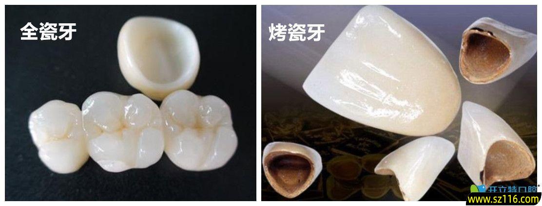 烤瓷牙临时牙套的图片？临时牙和烤瓷牙的区别