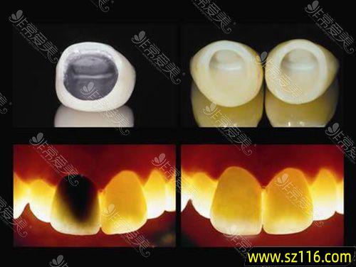 便宜的全瓷牙和贵的烤瓷牙，半烤瓷牙贵还是全烤瓷牙贵