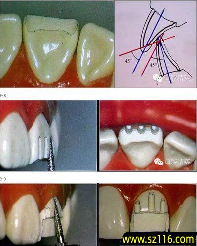 预备烤瓷牙的正确方法(烤瓷牙牙体预备的步骤)