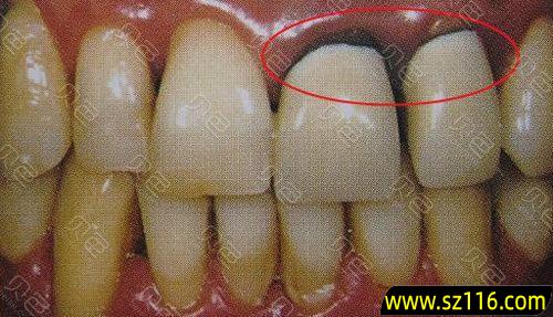 烤瓷牙取下后牙齿变黑，烤瓷牙发黑怎么办