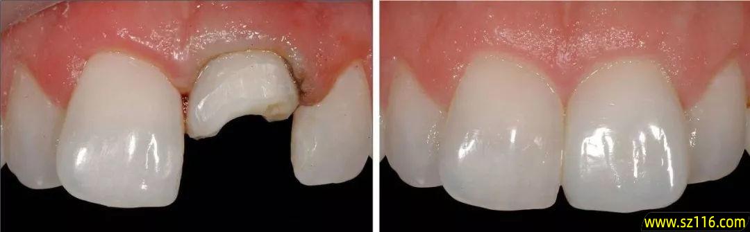 烤瓷牙断了怎么修补武汉 烤瓷牙冠里面的真牙断了怎么修补