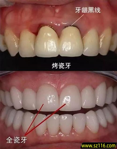 安烤瓷牙前磨牙方法，安装烤瓷牙过程中磨牙的危害