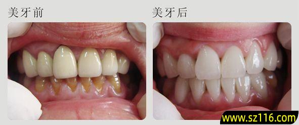 装个烤瓷牙能用几年 烤瓷牙可以用几年