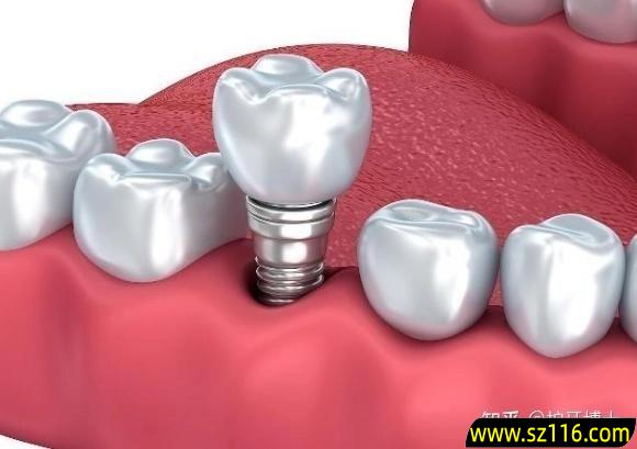 拔掉烤瓷牙装种植牙？固定烤瓷牙可以换种植牙吗