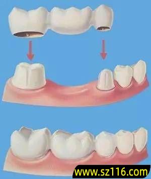 烤瓷牙应该怎么做 烤瓷牙做法