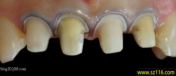 烤瓷牙牙龈长结石 烤瓷牙怎么才能变白