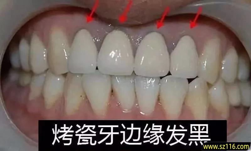 烤瓷牙能保留蛀牙吗？做烤瓷牙还用补蛀牙的洞吗，为什么