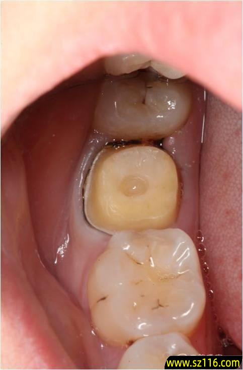 烤瓷牙为什么咬合痛 烤瓷牙咬合点高症状