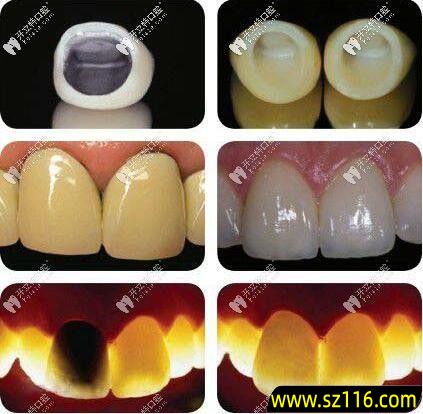 钛合金烤瓷牙会变黑，钴铬烤瓷牙长时间会变黑吗