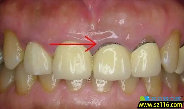 烤瓷牙会长牙龈吗 牙龈切除多了做烤瓷牙，牙龈还会长吗为何