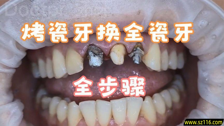 烤瓷牙如何完整拆除？拆烤瓷牙的方法