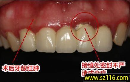 烤瓷牙金属刺激牙龈 镶完烤瓷牙后出现牙龈肿痛怎么办