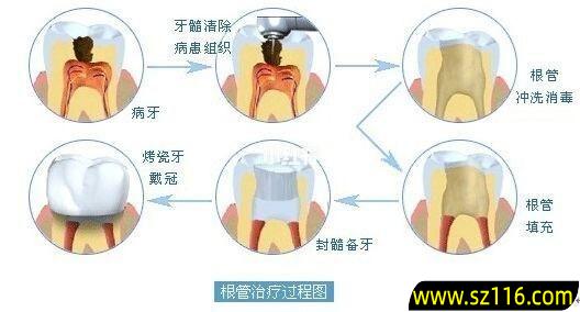 如何发现烤瓷牙继发龋，做过烤瓷的牙出现根尖周炎怎么办