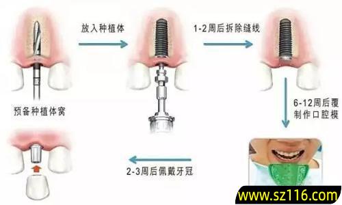 做烤瓷牙步骤图(安烤瓷牙的过程)