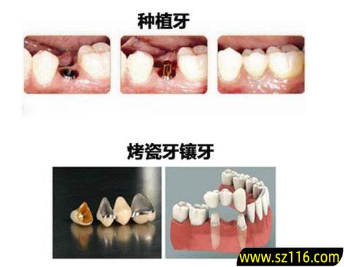 种植牙对比烤瓷牙？烤瓷牙和种植牙区别的是什么