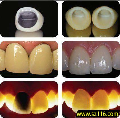 种烤瓷牙好 吗 为什么能不做烤瓷牙尽量不要做