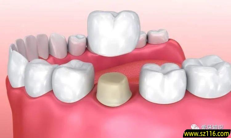 牙齿蛀牙做了烤瓷牙 烤瓷牙修补方法