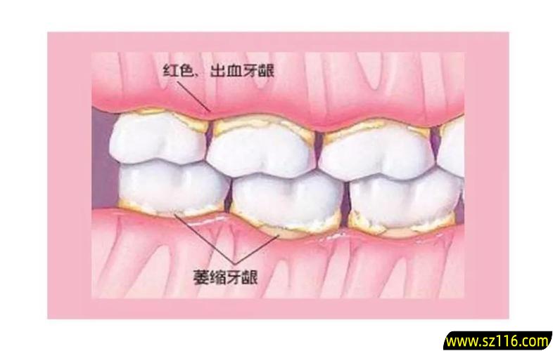 烤瓷牙把牙龈修复 拔牙引起旁边烤瓷牙的牙龈萎缩，露出牙根，该怎么办