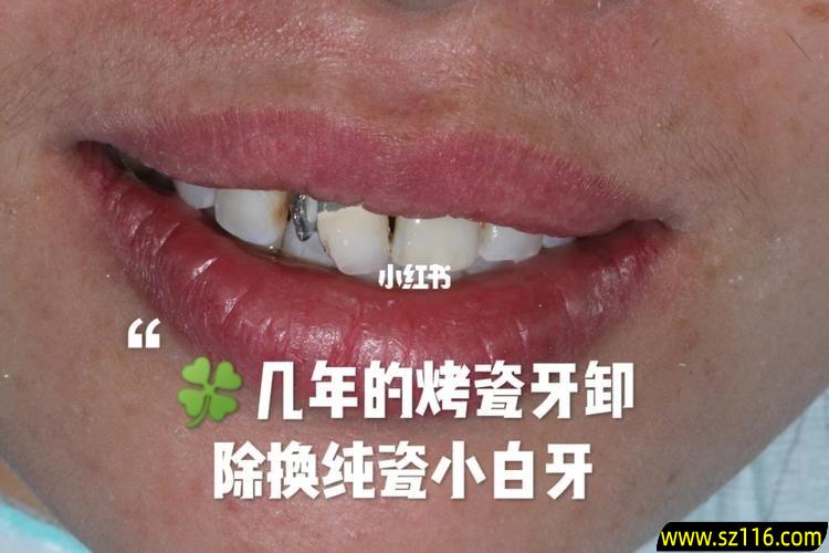 烤瓷牙几年后隐痛？烤瓷牙做了几年了突然很疼需要拆除吗