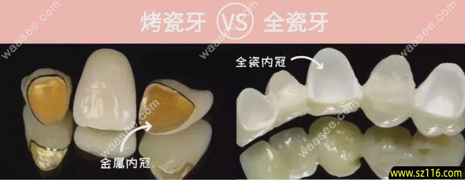 半颗牙装烤瓷牙？半烤瓷牙贵还是全烤瓷牙贵