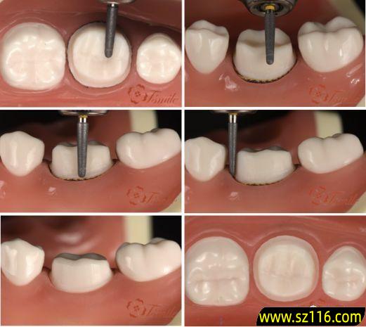 烤瓷牙预备多深，烤瓷牙一颗安装过程