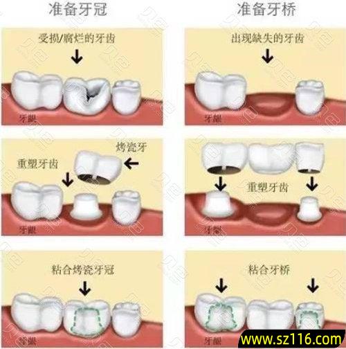 烤瓷牙需要拔牙嘛 拔牙后何时镶牙合适