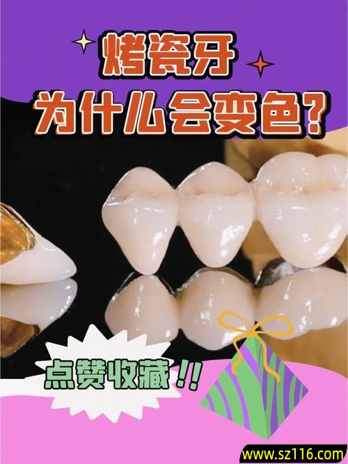 做侧牙烤瓷牙？烤瓷牙可以贴瓷片吗