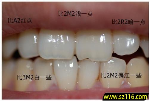 烤瓷牙颜色咋选择？烤瓷牙的颜色选黄一点还是白一点