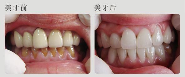 几岁可以修烤瓷牙 烤瓷牙几岁可以做