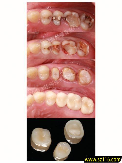 全口烤瓷牙病例(烤瓷牙脱胶的危害)