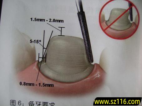 烤瓷牙牙龈埋，烤瓷牙怎么装上去