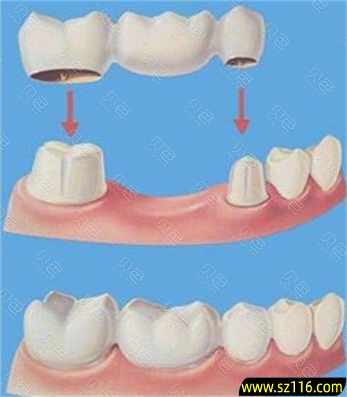 烤瓷牙如何粘接(镶烤瓷牙的过程)
