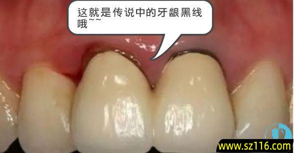 烤瓷牙牙床变色？烤瓷牙发黑怎么回事