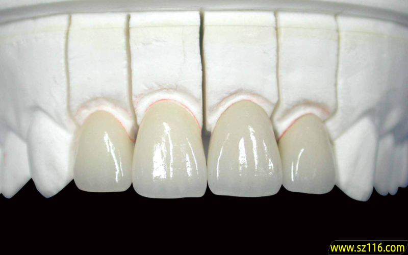 烤瓷牙 连冠 塞？医生为什么建议做连冠烤瓷牙