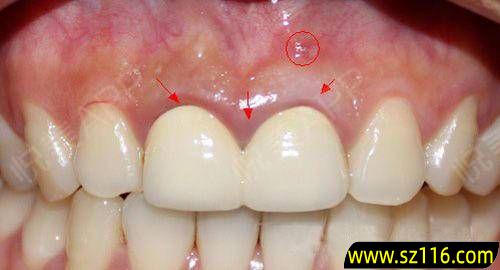 烤瓷牙牙龈损伤 镶完烤瓷牙后出现牙龈肿痛怎么办