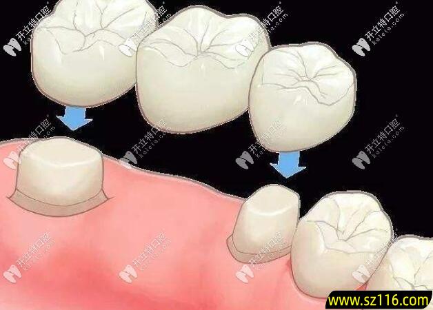 烤瓷牙齿戴牙 烤瓷牙怎么安装过程