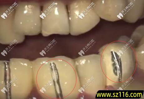 烤瓷牙能拆除几次？烤瓷牙能拆下来吗