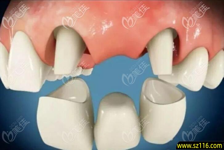 烤瓷牙支撑点 烤瓷牙怎么固定在牙上