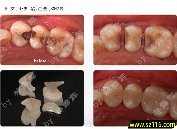 大牙蛀空了 烤瓷牙 蛀牙烤瓷牙里是螺丝钉固定的吗