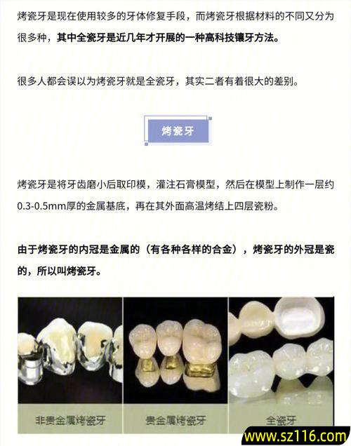 如何判断烤瓷牙材料(烤瓷牙材料怎么选)